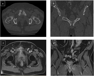 Management of Medium and Long Term Complications Following Prostate Cancer Treatment Resulting in Urinary Diversion – A Narrative Review